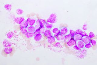 Peut-on guérir d’une leucémie myéloïde chronique. Image de cellules leucémiques.