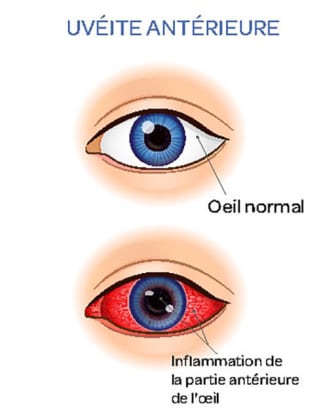 uvéite