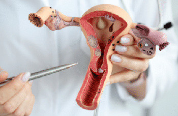 traitement endometre