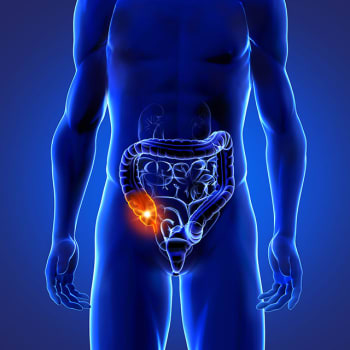 péritonite représentation