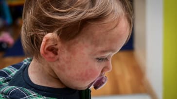 rougeole : vue d'un jeune enfant avec des boutons rouges sur le visage.