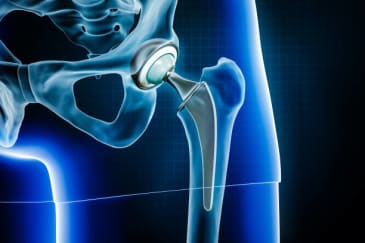 Hip replacement X-RAY