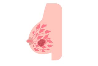 Illustration sein avec un kyste mammaire