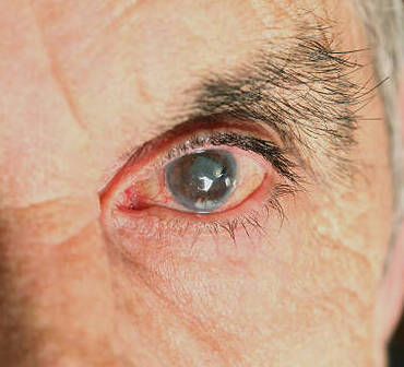 glaucome symptomes
