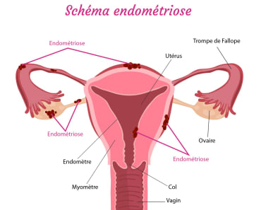 schéma endométriose