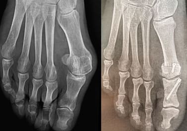 L’hallux valgus dr thiounn