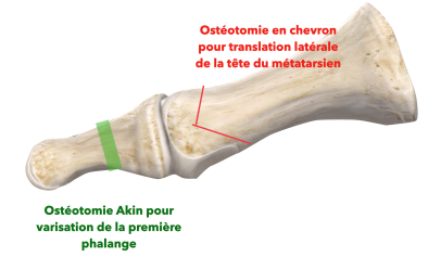 L’hallux valgus