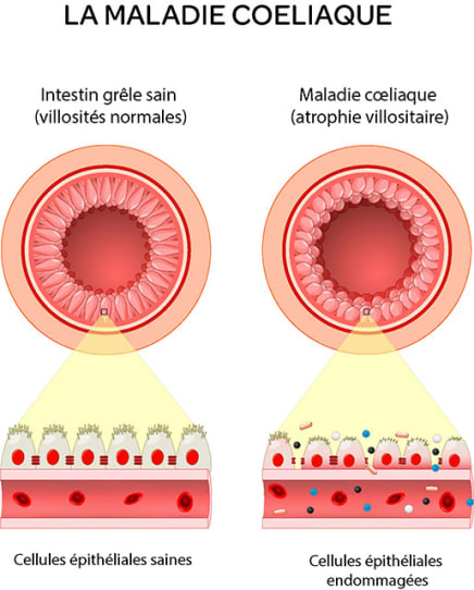 maladie coeliaque schéma
