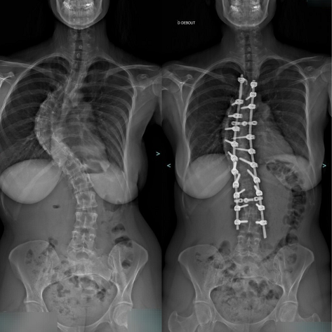 operation chirurgie de la scoliose avant apres le mans pole sante sud elsan