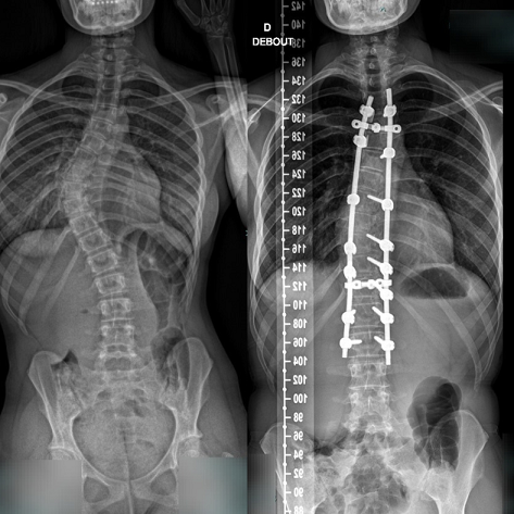 operation chirurgie de la scoliose avant apres le mans pole sante sud elsan