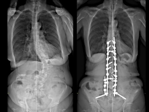 scoliose