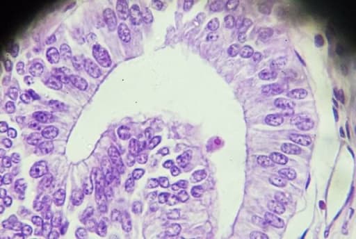 adenomyose