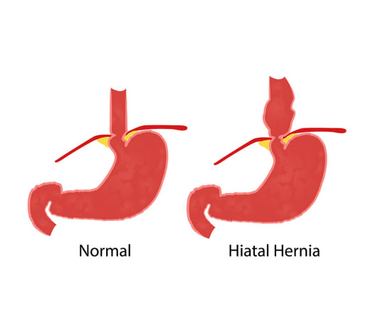 hernie hiatale schema
