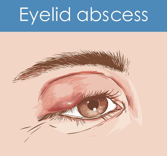chalazion schema