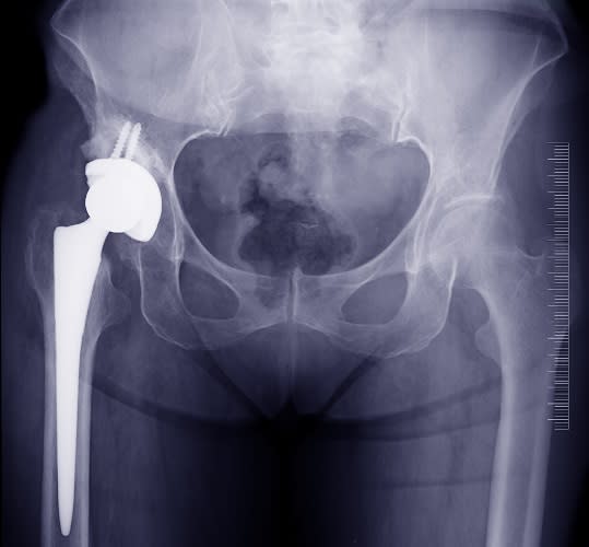 prothese de hanche