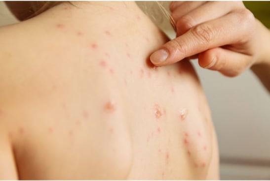 Varicelle : boutons caractéristiques sur le dos d'un enfant.