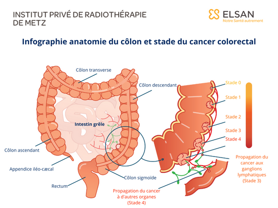 Stade cancer colon colorectal