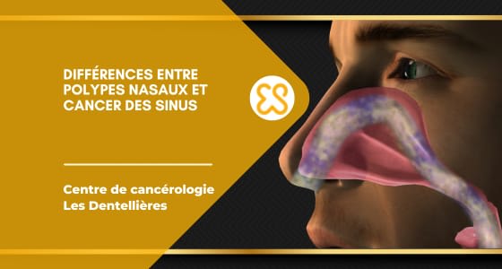 Différences entre polypes nasaux et cancer des sinus
