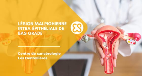 Lésion malpighienne intra-épithéliale de bas grade