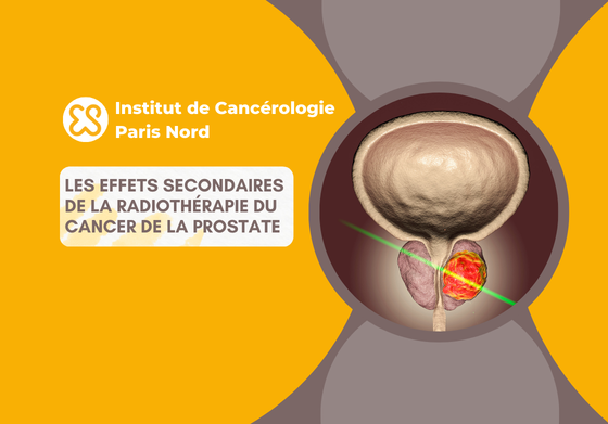 Les effets seondaires de la radiothérapie dans le traitement du cancer de la prostate
