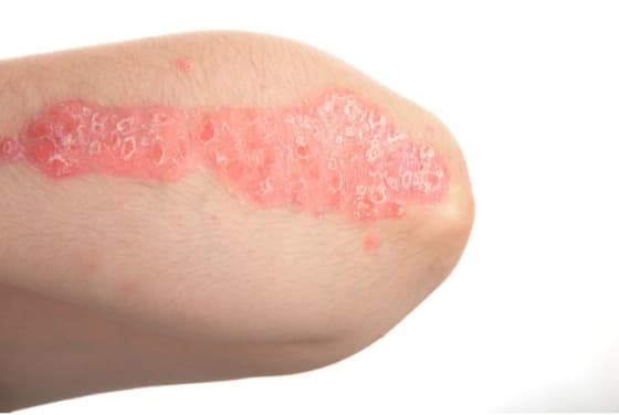 Manifestation du psoriasis : plaques rouges au niveau du coude.