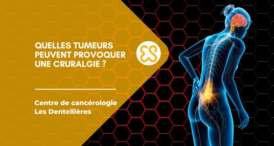 Quelles tumeurs peuvent provoquer une cruralgie ?