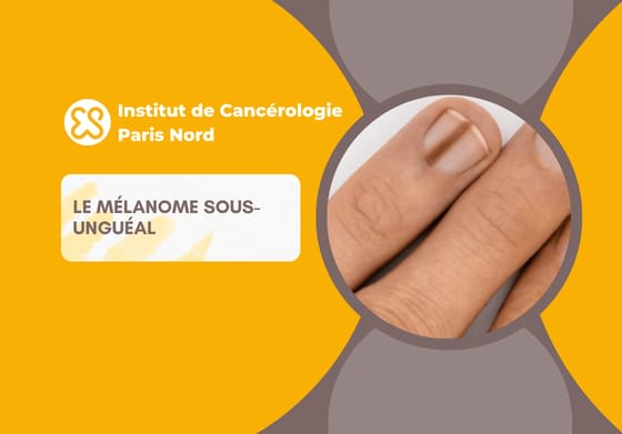 Le mélanome sous-unguéal