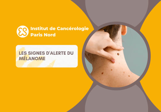 Les signes d'alerte du mélanome