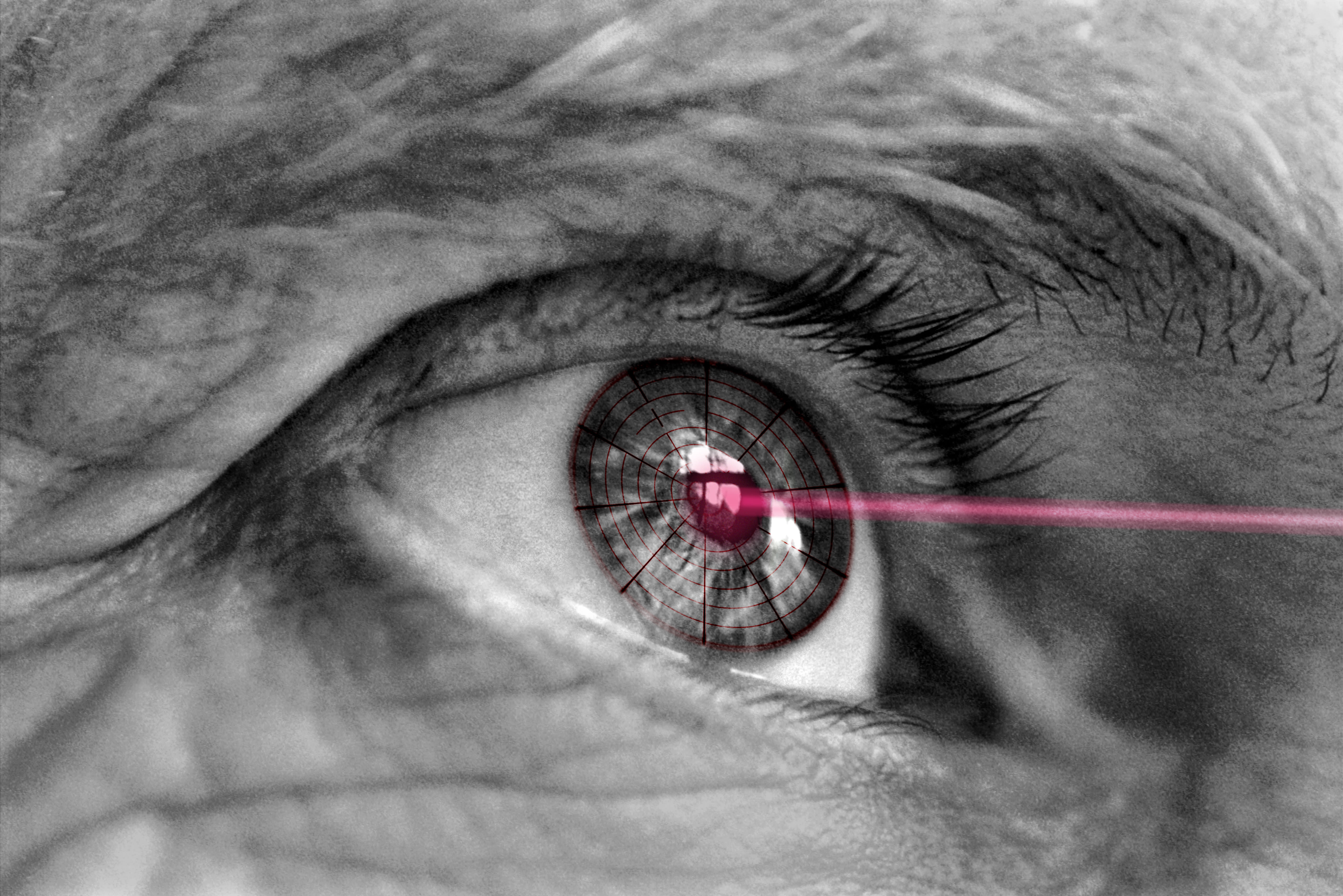Chirurgie réfractive somain