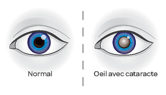 Illustration comparative de deux yeux : à gauche, un œil normal avec une pupille noire ; à droite, un œil atteint d'une cataracte, dont la pupille présente une opacité gris-blanc. Les légendes indiquent « Normal » et « Œil avec cataracte », séparées par une ligne verticale en pointillés.