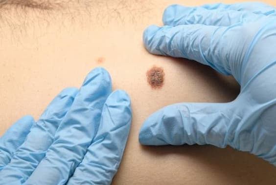 Cancer de la peau. Mains gantées d'un soignant en train d'inspecter un grain de beauté aux contours irréguliers et imposant qui pourrait être un mélanome.