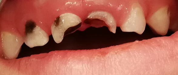dent