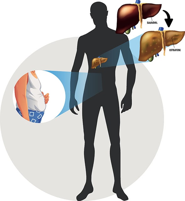 cancer du foie diagnostic
