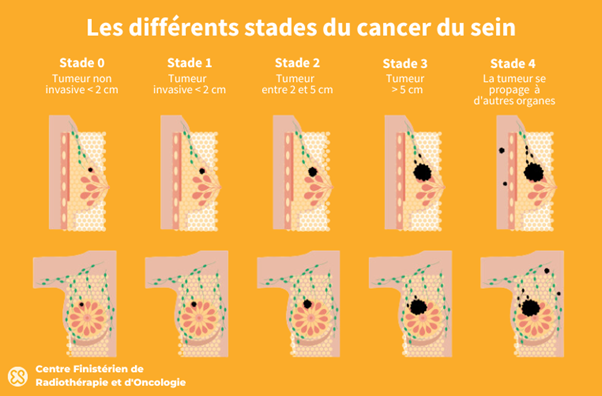 Les différents stades du cancer du sein