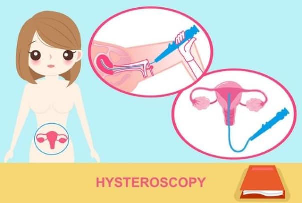 hysteroscopie deroulement