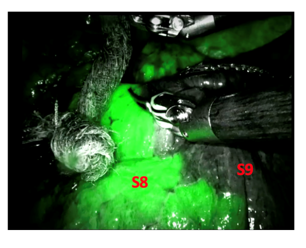 Vue per-opératoire d’utilisation du vert d’indocyanine