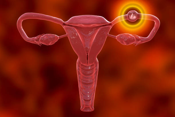 grossesse extra uterine