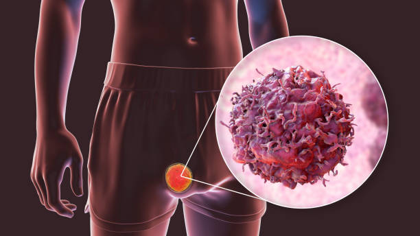 Cancer des testicules
