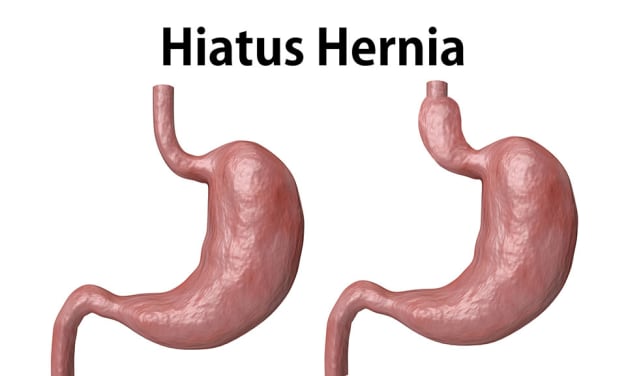 hernie hiatale