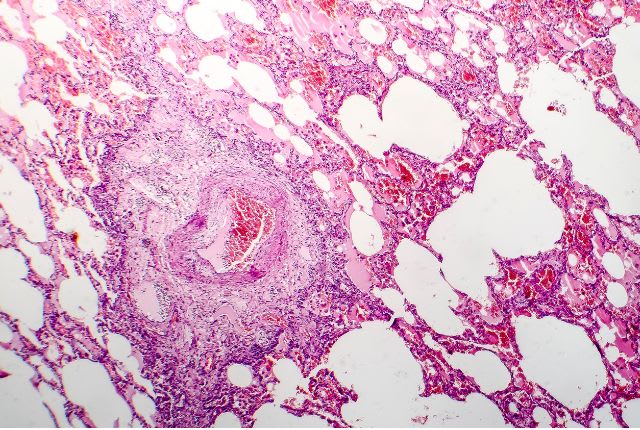 œdème pulmonaire