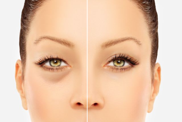 Blépharoplastie