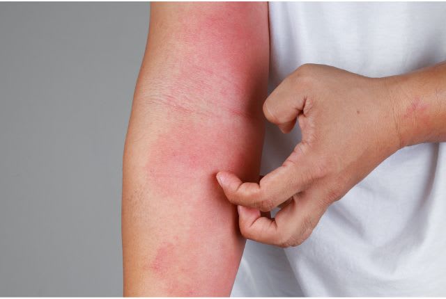 Eczéma