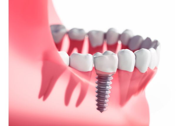 Implant dentaire
