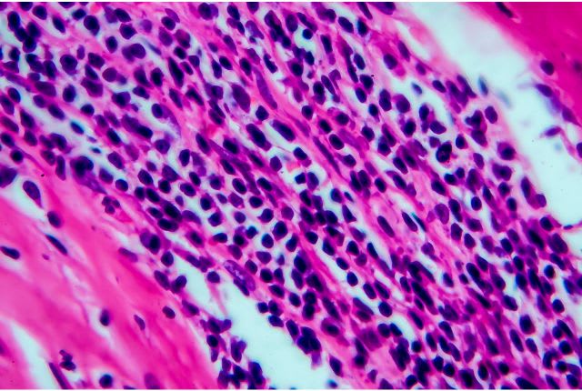 Lymphome de Hodgkin