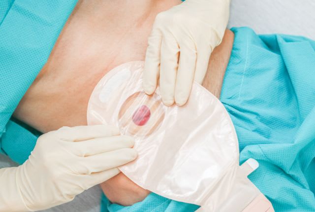 Colostomie