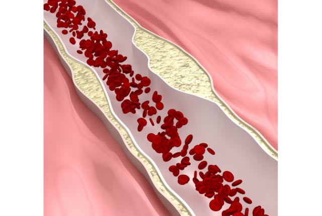 Athérosclérose