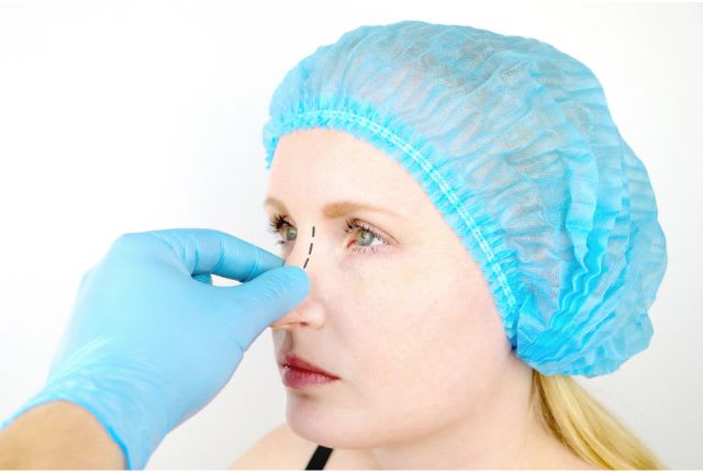 Rhinoplastie