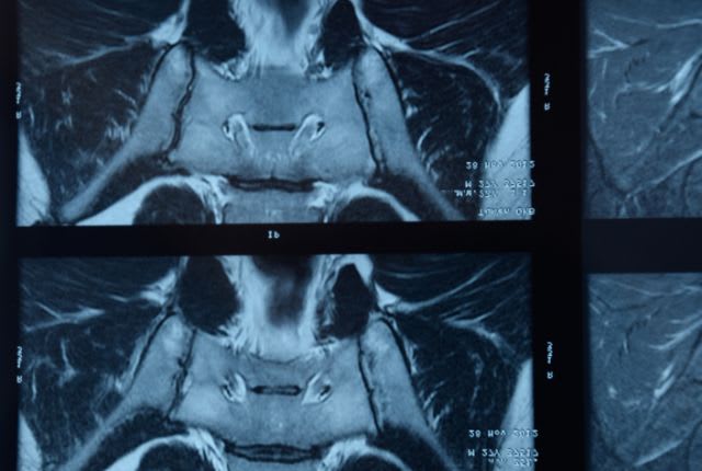 Spondylarthrite
