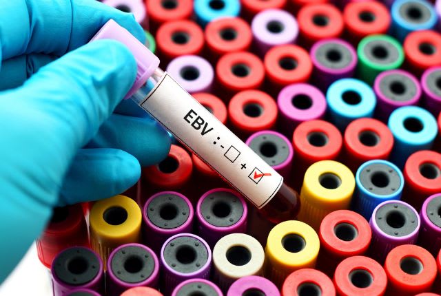 Virus Epstein-Barr (EBV) : échantillon de sang prêt à être testé.