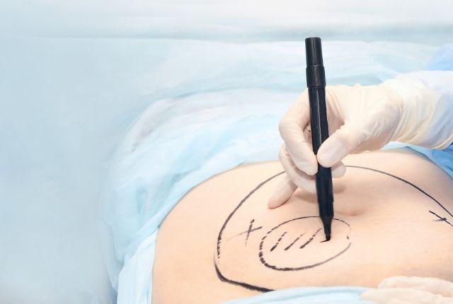 Abdominoplastie : un ou une soignante trace au feutre sur le ventre d'un ou d'une patiente le déroulé de son intervention.